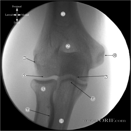 A/P Elbow Xray