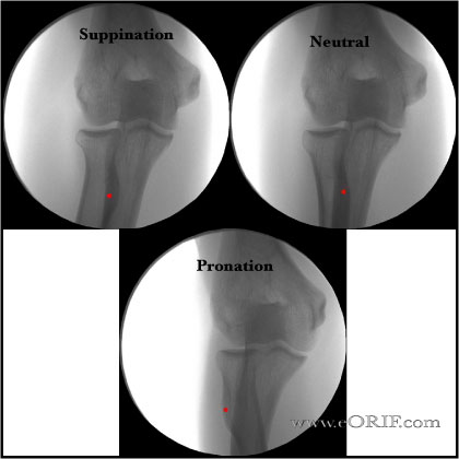 A/P Elbow Xray