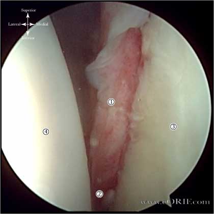 Bankart lesions arthroscopic picture