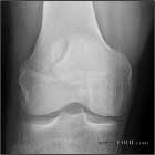 bipartitie patella AP bipartitie patella AP