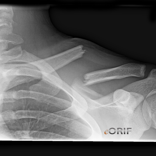 clavicle fracture sonoma nail clavicle fracture sonoma nail