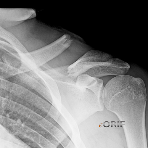 clavicle fracture sonoma nail clavicle fracture sonoma nail