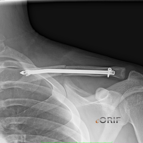 clavicle fracture sonoma nail clavicle fracture sonoma nail