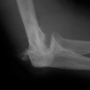 distal humerus fracture xray distal humerus fracture
