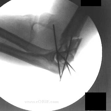 distal humerus fracture xray distal humerus fracture