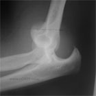 Elbow Dislocation Xray Elbow Dislocation Xray