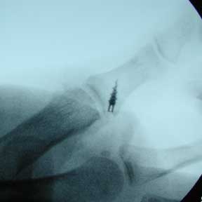 thumb UCL repair xray thumb UCL repair xray