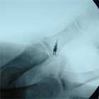 Skiers thumb repair xray Gamekeepers Repair