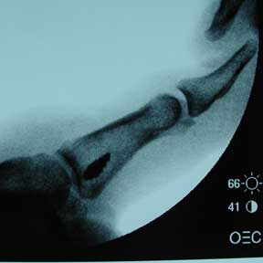 thumb UCL repair xray thumb UCL repair xray