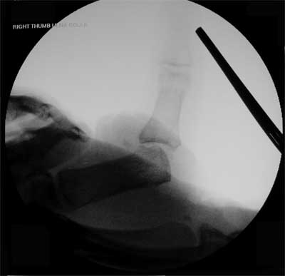 Gamekeeper's Skier's thumb xray Gamekeeper's Skier's thumb xray
