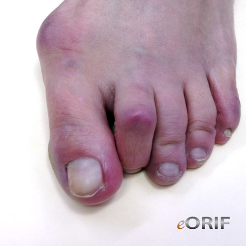 hammer toe hammer toe