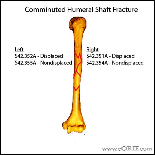 Comminuted humeral shaft fracture ICD-10 classification Comminuted humeral shaft fracture ICD-10 classification