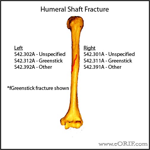Humeral Shaft fracture ICD-10 classification Humeral Shaft fracture ICD-10 classification