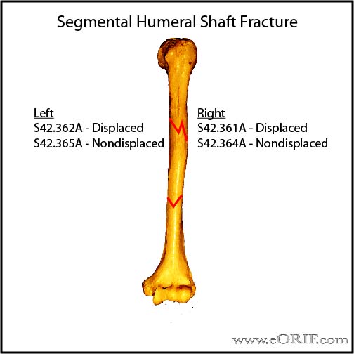 Segmental humeral shaft fracture ICD-10 classification Segmental humeral shaft fracture ICD-10 classification