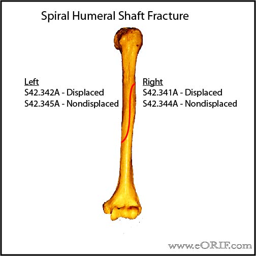 Spiral humeral shaft fracture icd-10 classification Spiral humeral shaft fracture icd-10 classification