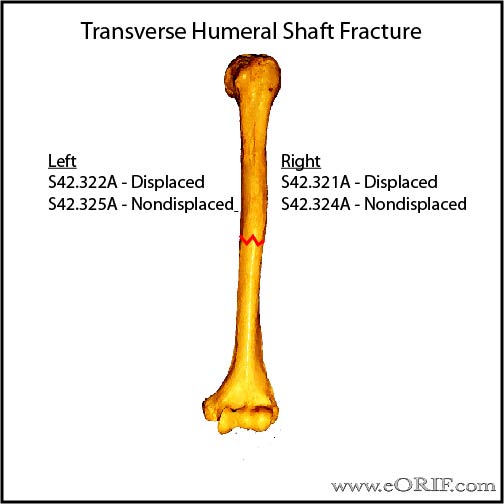 Transverse humeral shaft fracture icd-10 classification Transverse humeral shaft fracture icd-10 classification