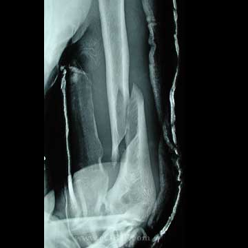 distal 1/3 humeral shaft fracture distal 1/3 humeral shaft fracture