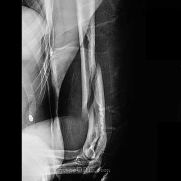 distal 1/3 humeral shaft fracture distal 1/3 humeral shaft fracture