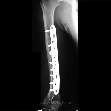 humeral shaft fracture ORIF humeral shaft fracture ORIF