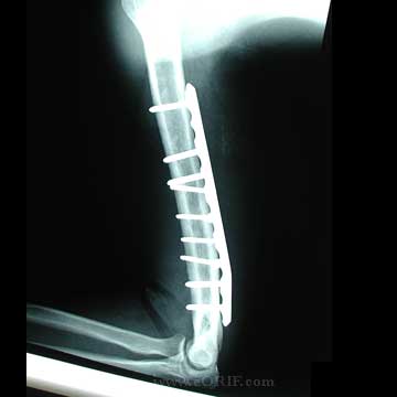 humeral shaft fracture ORIF xray humeral shaft fracture ORIF xray