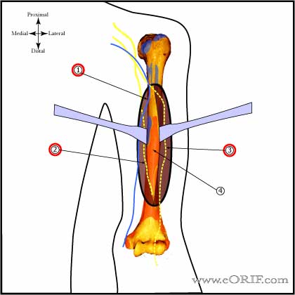 anterior lateral approach humerus image