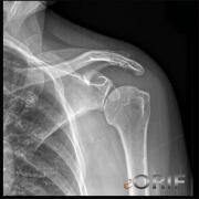 inferior humeral head subluxation