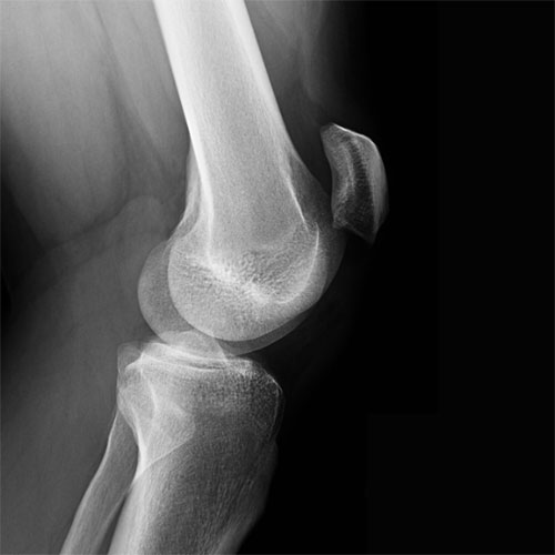 patellar alta xray