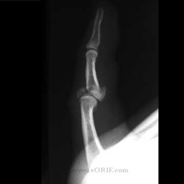 PIP Pilon fracture PIP joint pilone fracture xray