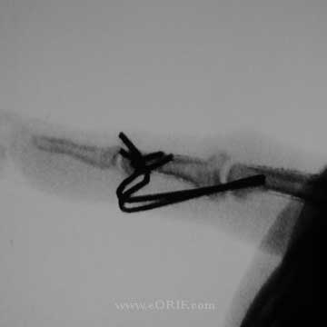 PIP joint external fixation PIP joint external fixation xray
