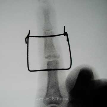 PIP Pilone external fixation PIP Pilon external fixation xray