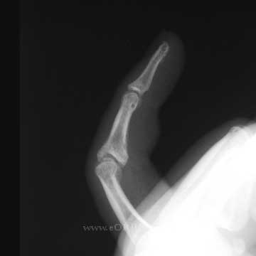 PIP fracture dislocation xray PIP fracture xray