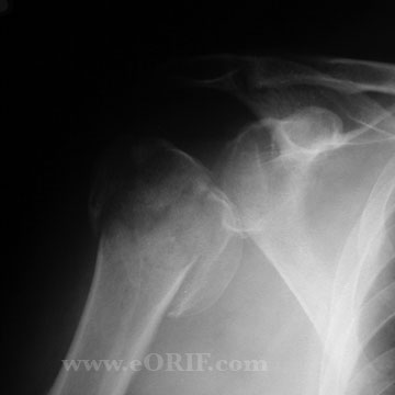 Proximal Humerus Fracture xray Proximal Humerus Fracture xray