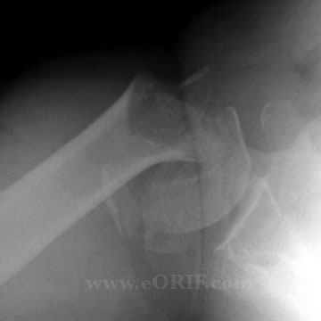 Proximal Humerus Fracture xray Proximal Humerus Fracture xray