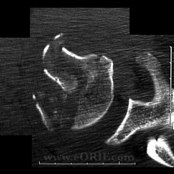 Proximal Humerus Fracture CT Proximal Humerus Fracture CT