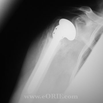 Proximal humerus hemiarthoplasty xray