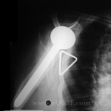 Proximal Humerus Fracture hemiarthroplasty Proximal Humerus Fracture hemiarthroplasty
