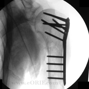 Proximal humerus ORIF xray