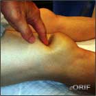 quad tendon rupture quad tendon rupture