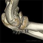 Radial Head Type II Fracture CT scan