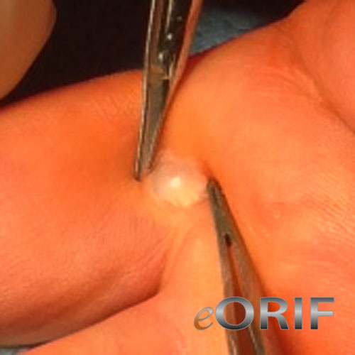 Ganglion of tendon sheath picture retinacular cyst picture