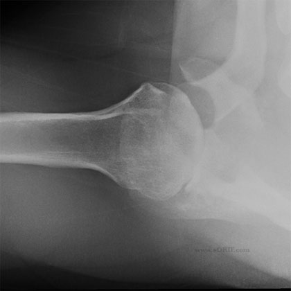 shoulder arthritis xray