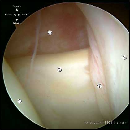 subscapularis arthroscopic picture