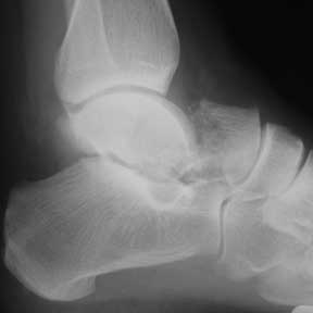 Talus neck fracture xray Talar neck fracture lateral xray