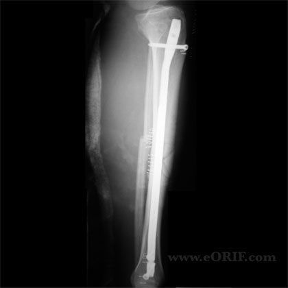 Tibial shaft IM nail xray Tibial shaft lateral view IM nail xray