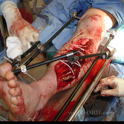 Grade IIIC open fracture Ex Fracture image Grade IIIC open fracture external fixation image