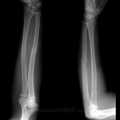 ulnar shaft fracture xray