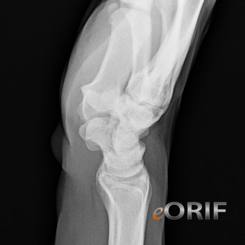 wrist lateral xray